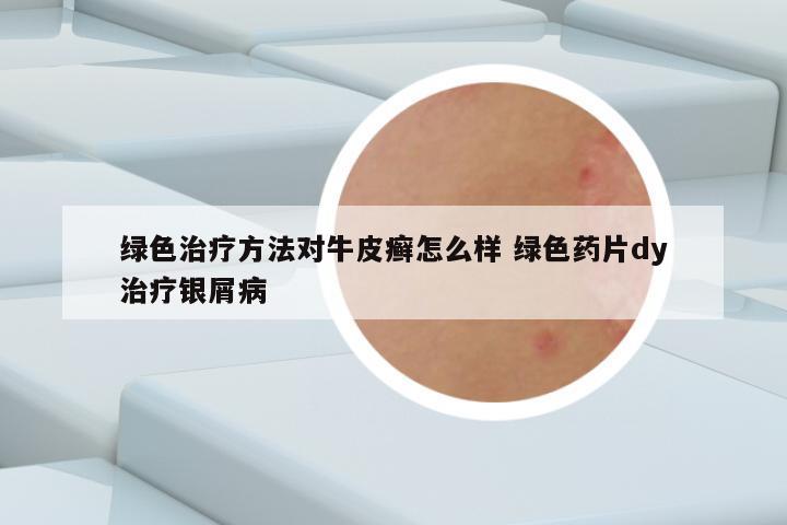 绿色治疗方法对牛皮癣怎么样 绿色药片dy治疗银屑病