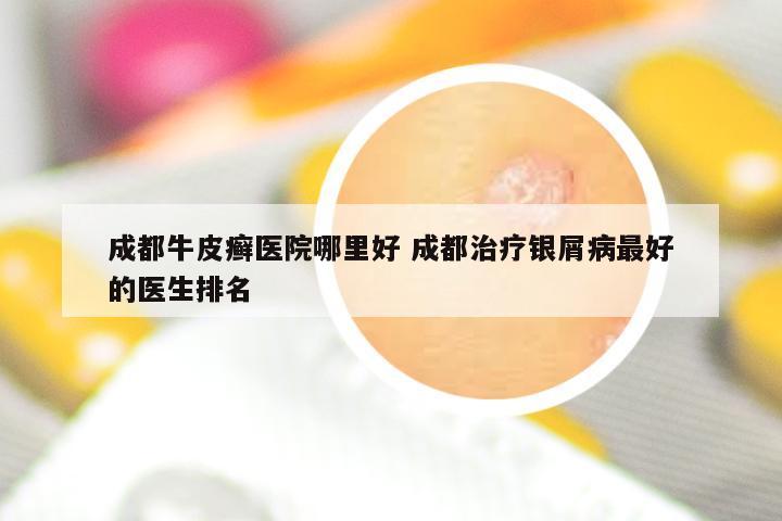 成都牛皮癣医院哪里好 成都治疗银屑病最好的医生排名