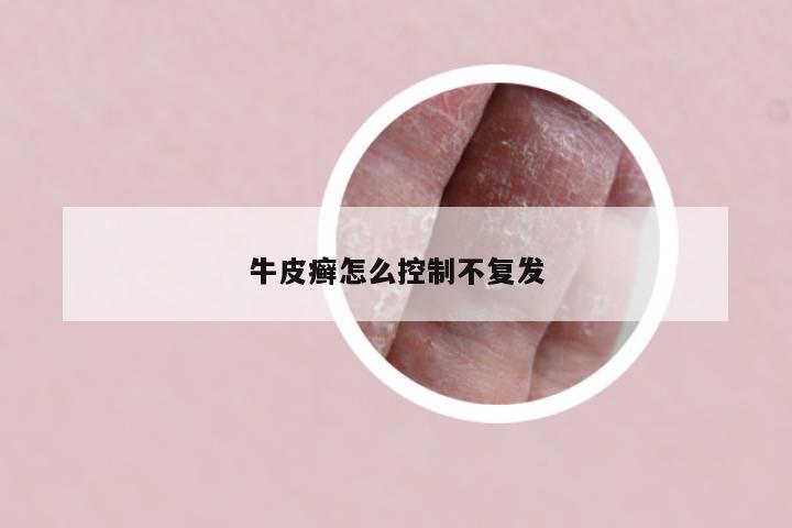 牛皮癣怎么控制不复发