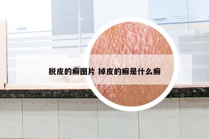 脱皮的癣图片 掉皮的癣是什么癣