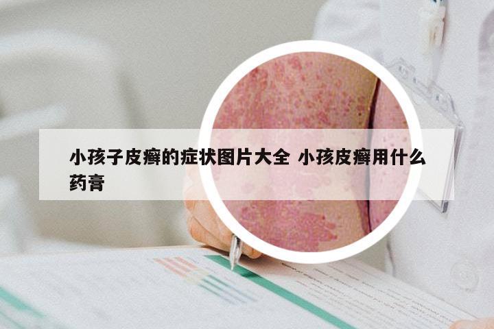 小孩子皮癣的症状图片大全 小孩皮癣用什么药膏
