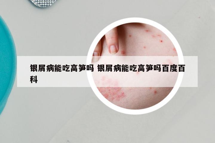 银屑病能吃高笋吗 银屑病能吃高笋吗百度百科