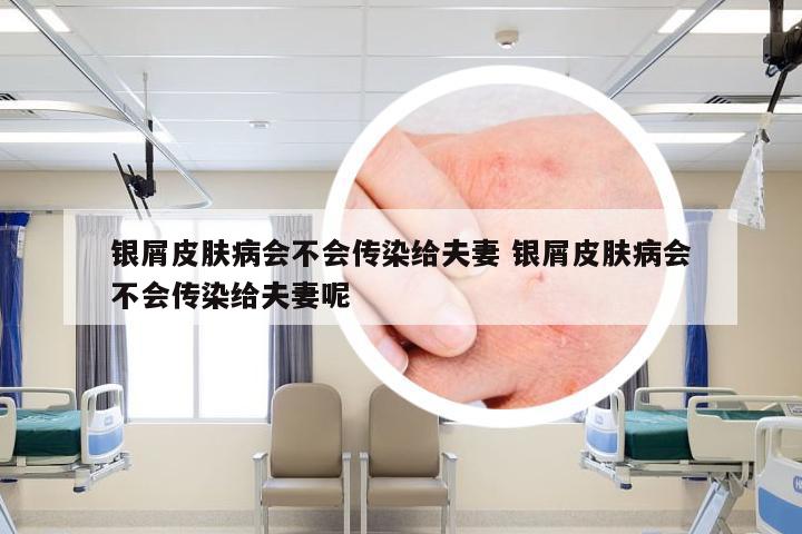 银屑皮肤病会不会传染给夫妻 银屑皮肤病会不会传染给夫妻呢