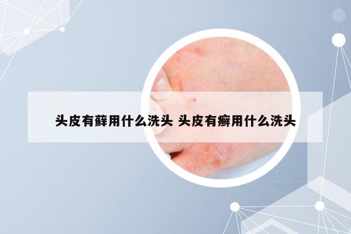 头皮有藓用什么洗头 头皮有癣用什么洗头