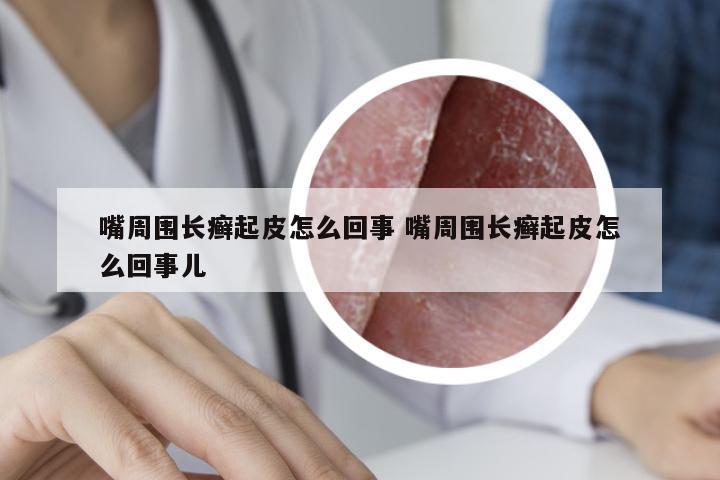 嘴周围长癣起皮怎么回事 嘴周围长癣起皮怎么回事儿
