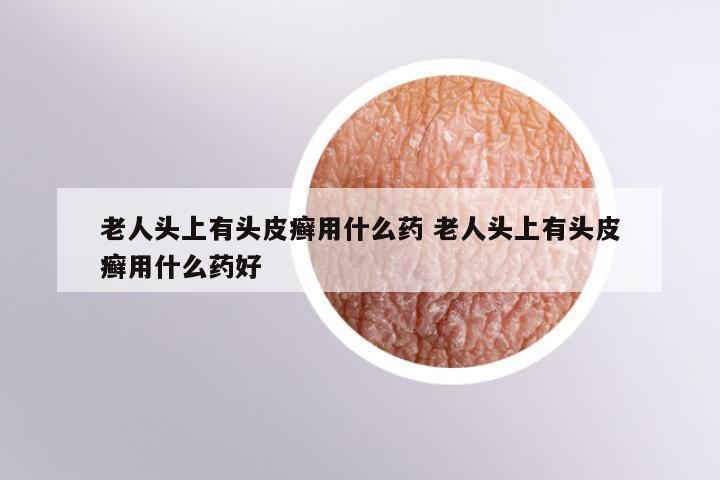老人头上有头皮癣用什么药 老人头上有头皮癣用什么药好