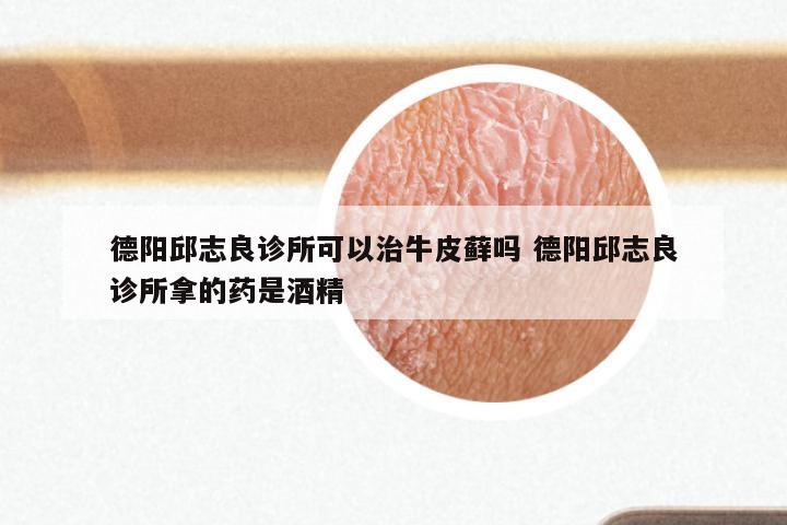 德阳邱志良诊所可以治牛皮藓吗 德阳邱志良诊所拿的药是酒精