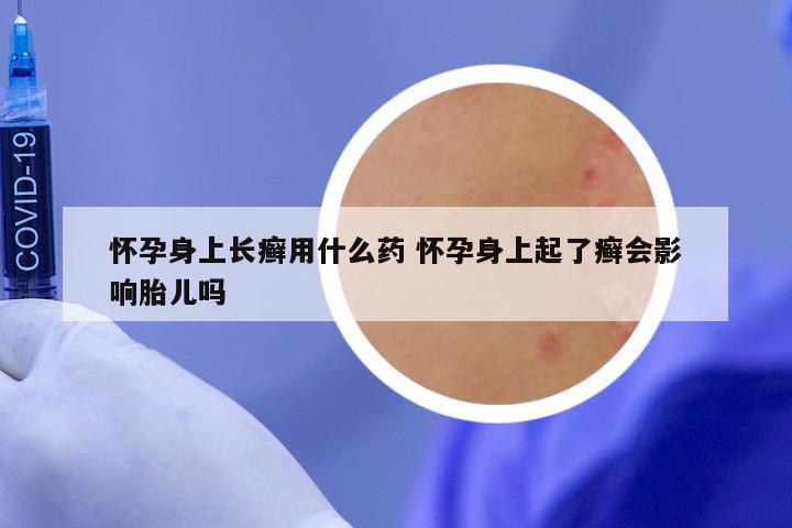 怀孕身上长癣用什么药 怀孕身上起了癣会影响胎儿吗