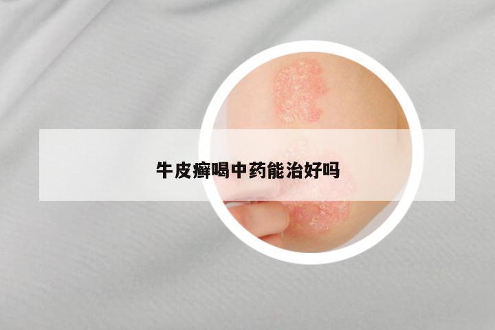 牛皮癣喝中药能治好吗