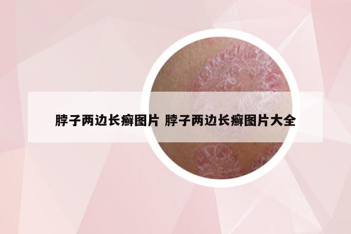 脖子两边长癣图片 脖子两边长癣图片大全