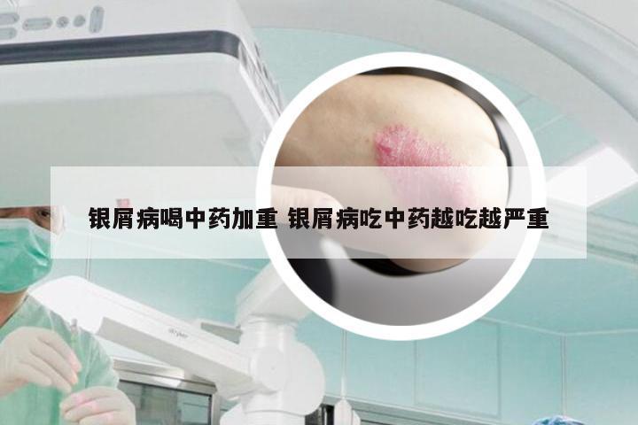 银屑病喝中药加重 银屑病吃中药越吃越严重