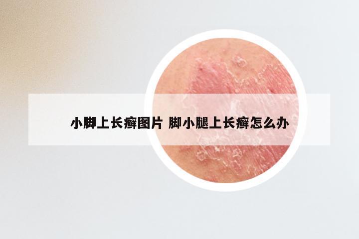 小脚上长癣图片 脚小腿上长癣怎么办