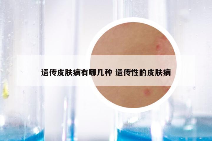 遗传皮肤病有哪几种 遗传性的皮肤病
