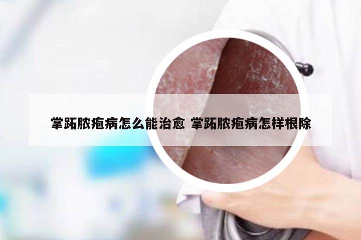 掌跖脓疱病怎么能治愈 掌跖脓疱病怎样根除