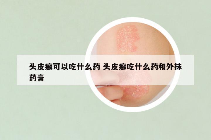 头皮癣可以吃什么药 头皮癣吃什么药和外抹药膏