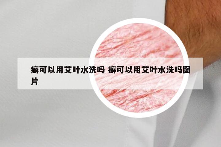 癣可以用艾叶水洗吗 癣可以用艾叶水洗吗图片