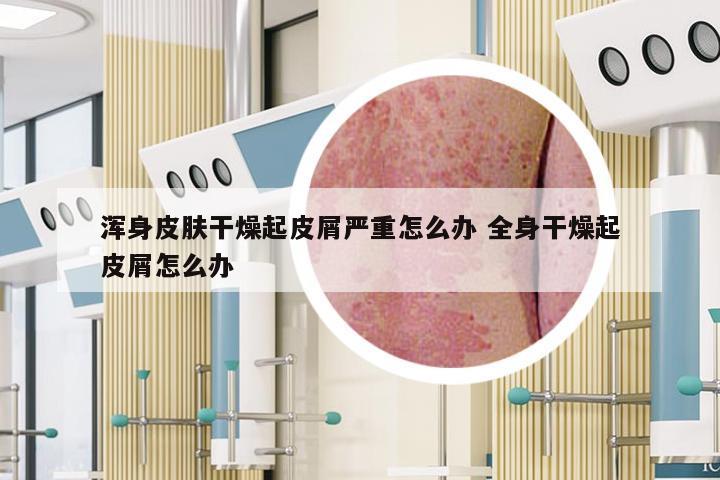浑身皮肤干燥起皮屑严重怎么办 全身干燥起皮屑怎么办