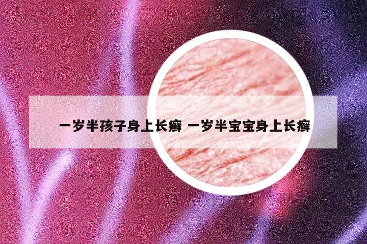 一岁半孩子身上长癣 一岁半宝宝身上长癣