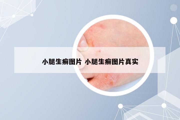 小腿生癣图片 小腿生癣图片真实