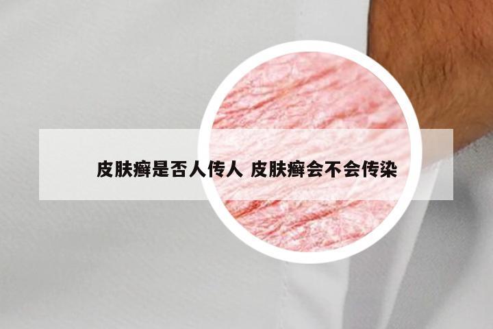 皮肤癣是否人传人 皮肤癣会不会传染