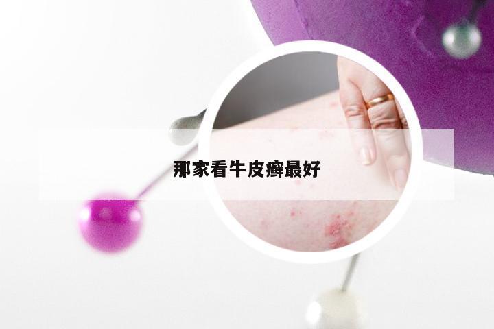 那家看牛皮癣最好