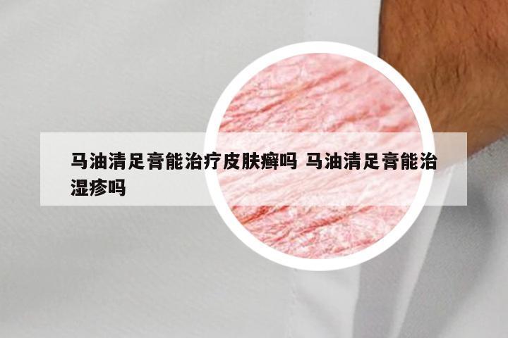 马油清足膏能治疗皮肤癣吗 马油清足膏能治湿疹吗