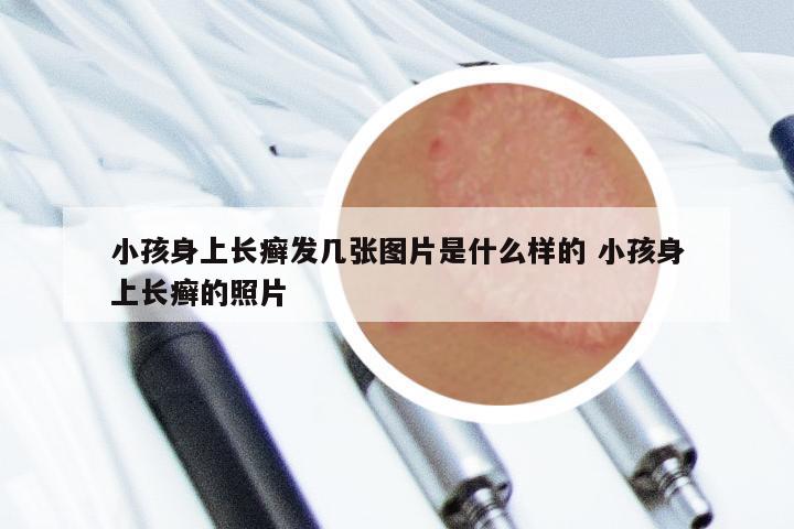 小孩身上长癣发几张图片是什么样的 小孩身上长癣的照片