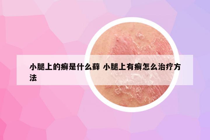 小腿上的癣是什么藓 小腿上有癣怎么治疗方法