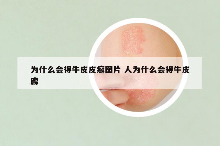 为什么会得牛皮皮癣图片 人为什么会得牛皮廨