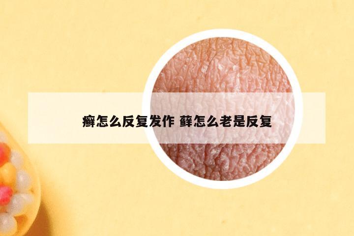 癣怎么反复发作 藓怎么老是反复