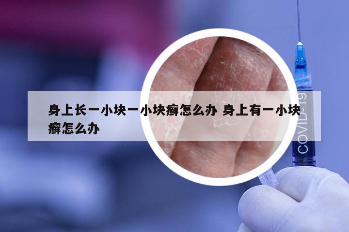 身上长一小块一小块癣怎么办 身上有一小块癣怎么办