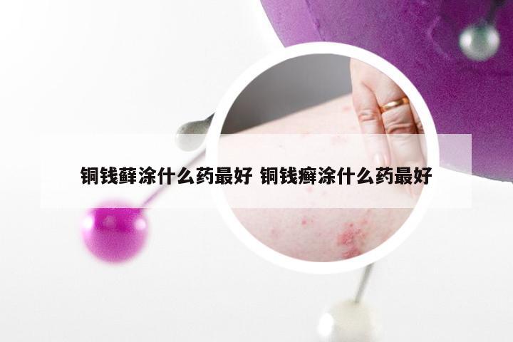 铜钱藓涂什么药最好 铜钱癣涂什么药最好