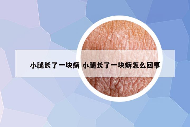 小腿长了一块癣 小腿长了一块癣怎么回事