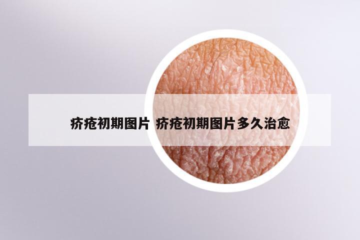 疥疮初期图片 疥疮初期图片多久治愈