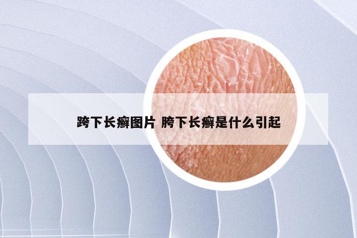 跨下长癣图片 胯下长癣是什么引起