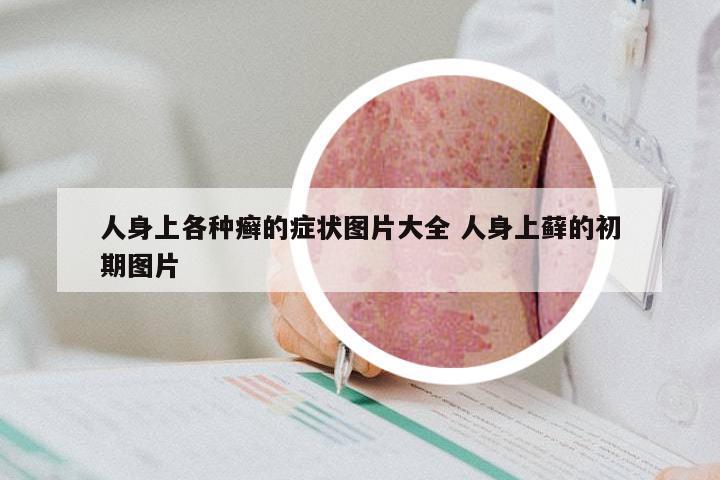 人身上各种癣的症状图片大全 人身上藓的初期图片