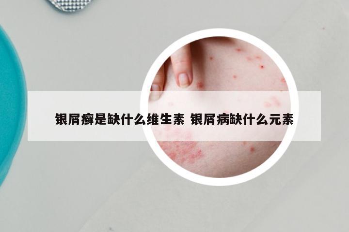 银屑癣是缺什么维生素 银屑病缺什么元素