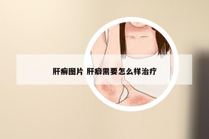 肝癣图片 肝癖需要怎么样治疗