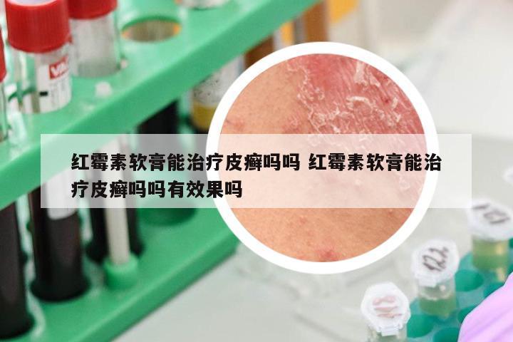 红霉素软膏能治疗皮癣吗吗 红霉素软膏能治疗皮癣吗吗有效果吗