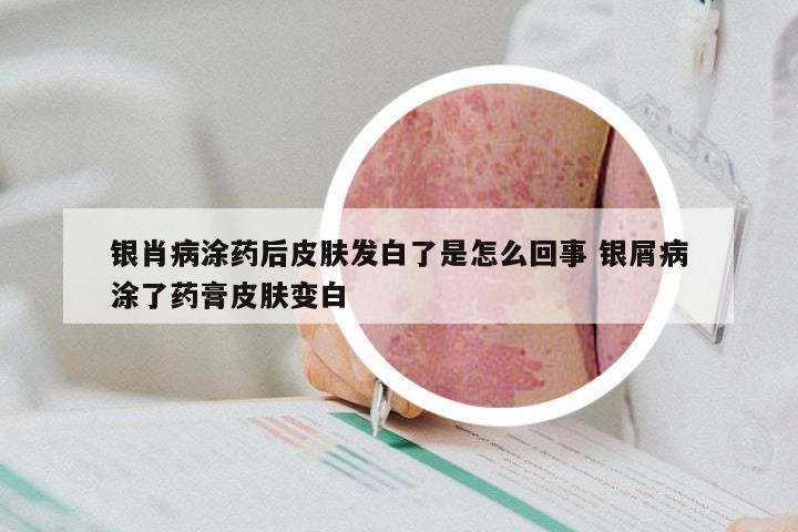 银肖病涂药后皮肤发白了是怎么回事 银屑病涂了药膏皮肤变白