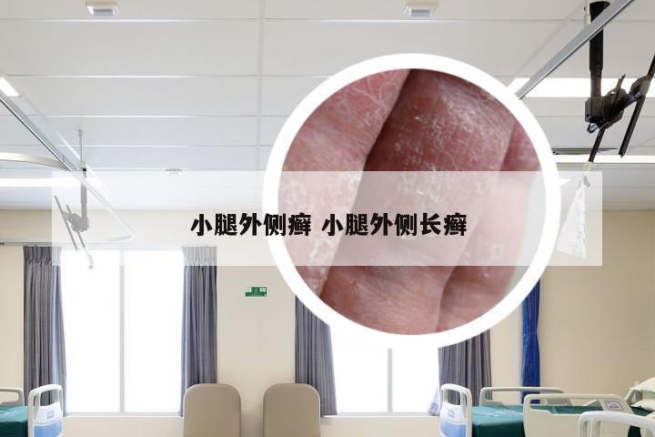 小腿外侧癣 小腿外侧长癣