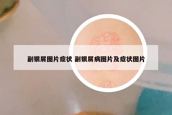 副银屑图片症状 副银屑病图片及症状图片