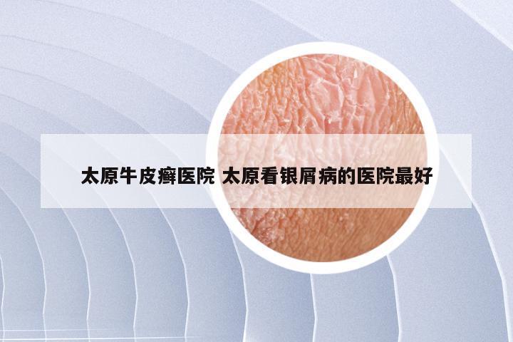 太原牛皮癣医院 太原看银屑病的医院最好
