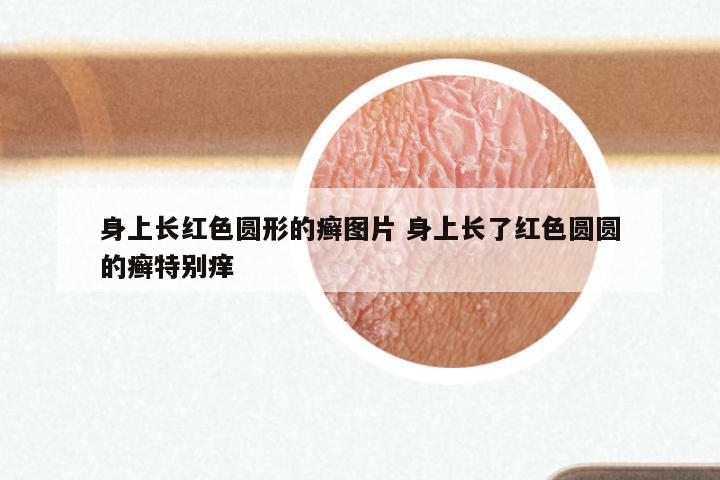 身上长红色圆形的癣图片 身上长了红色圆圆的癣特别痒
