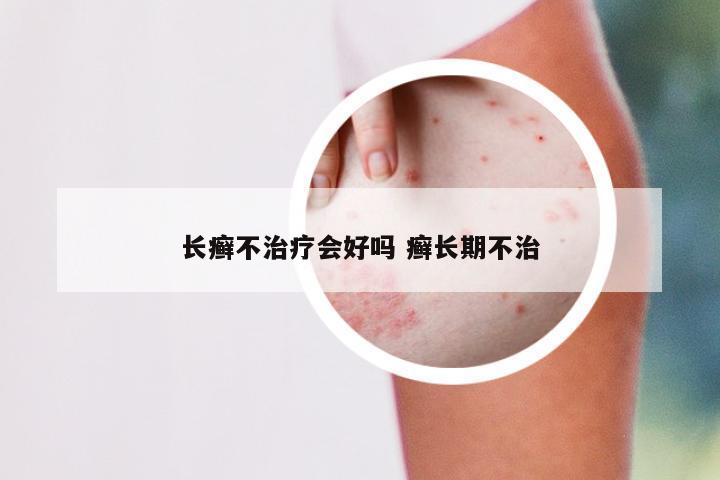 长癣不治疗会好吗 癣长期不治