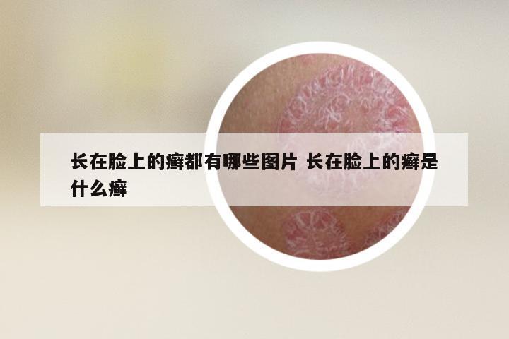 长在脸上的癣都有哪些图片 长在脸上的癣是什么癣