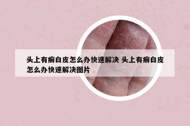 头上有癣白皮怎么办快速解决 头上有癣白皮怎么办快速解决图片