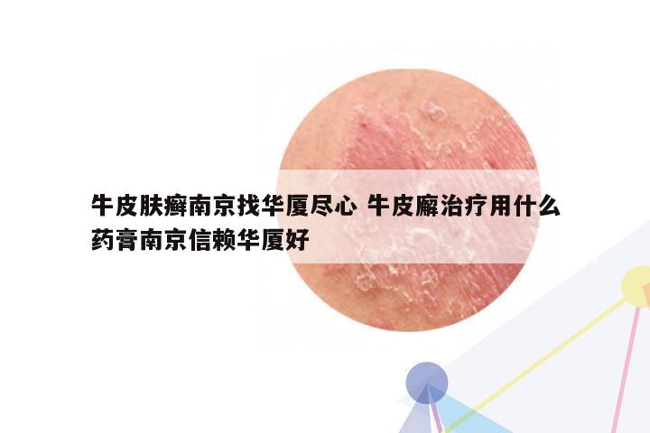 牛皮肤癣南京找华厦尽心 牛皮廨治疗用什么药膏南京信赖华厦好