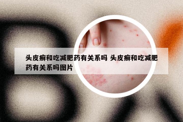 头皮癣和吃减肥药有关系吗 头皮癣和吃减肥药有关系吗图片