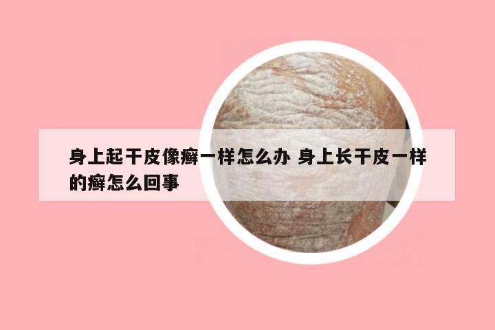 身上起干皮像癣一样怎么办 身上长干皮一样的癣怎么回事